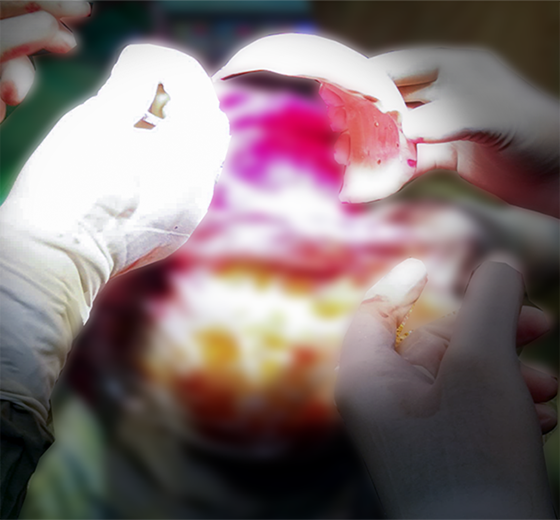 Cranium PEEK implant case 04